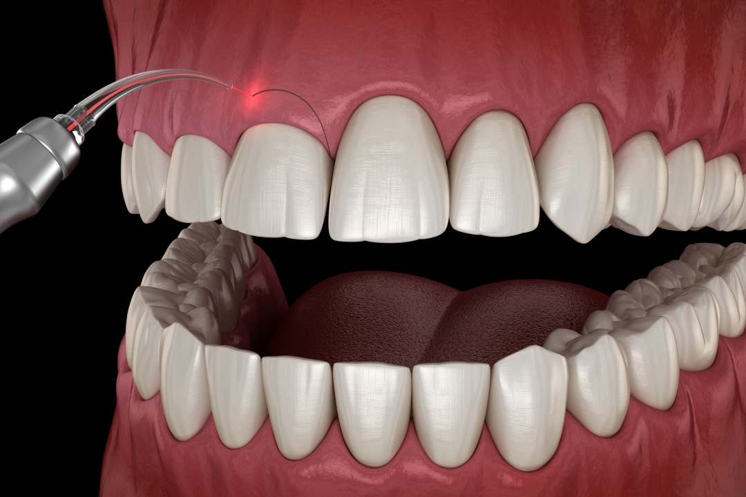 Lenoir City Laser Dentistry
