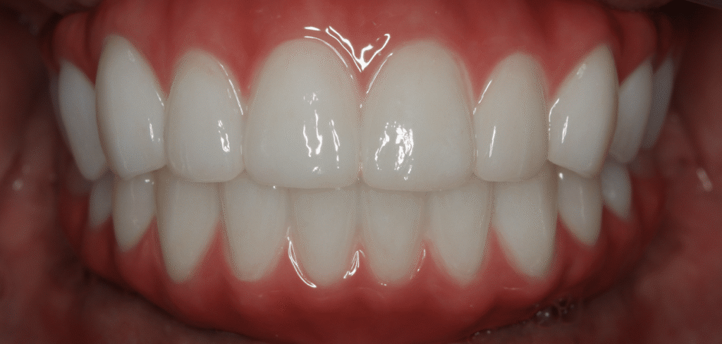 After Image: All On X Implant Supported Prostheses - front