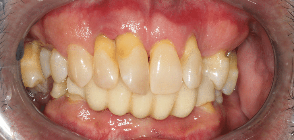Before Image: All On X Implant Supported Prostheses - front