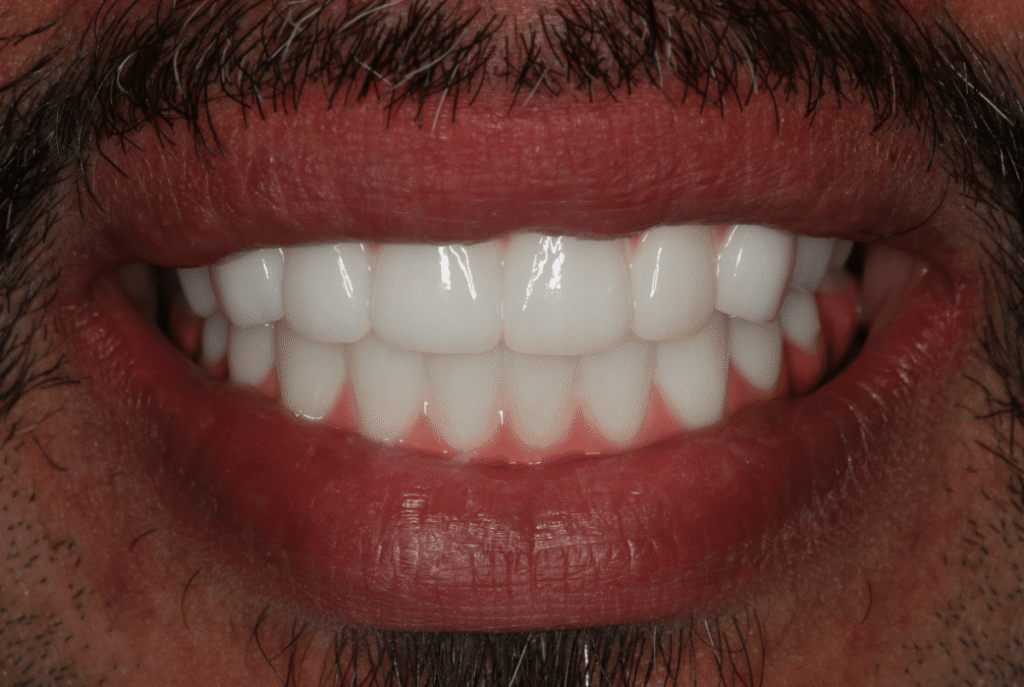 After Image: All On X Implant Supported Prostheses - front