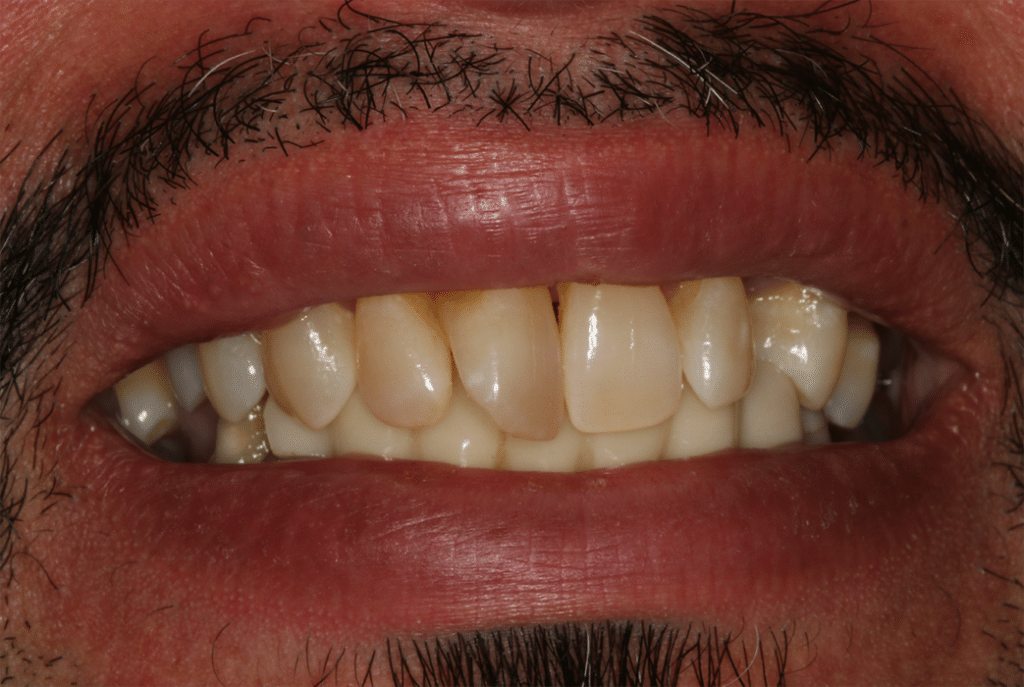 Before Image: All On X Implant Supported Prostheses - front