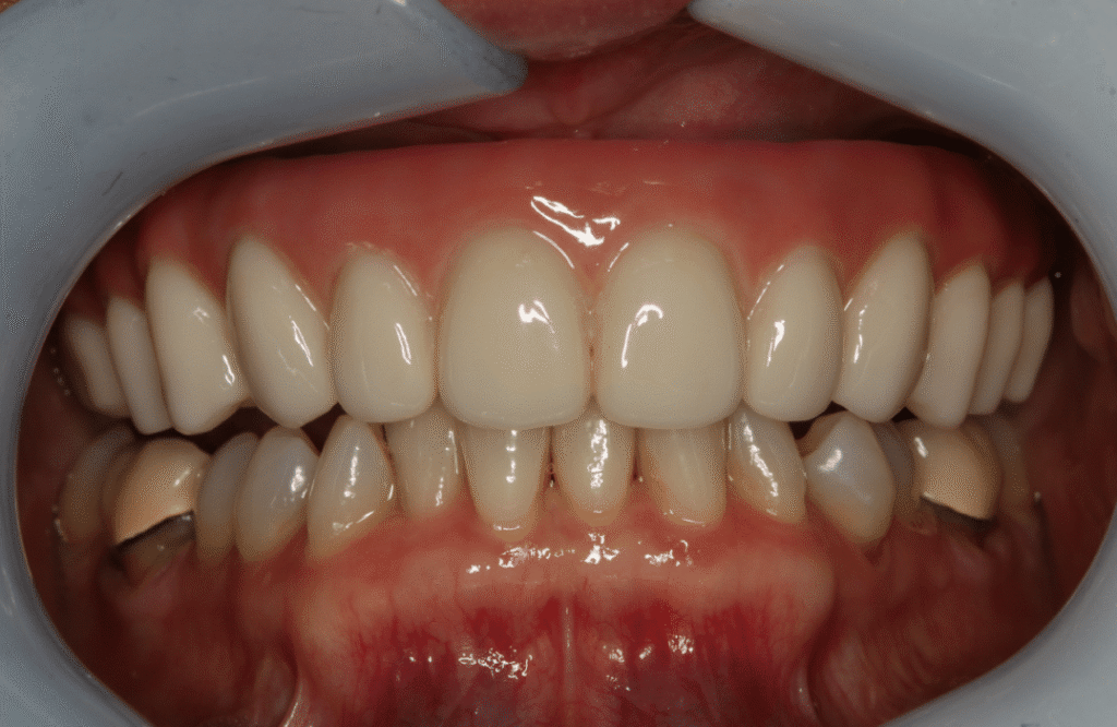 After Image: All on X Upper Prosthesis - front