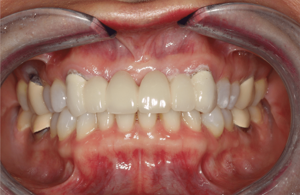 Before Image: All on X Upper Prosthesis - front