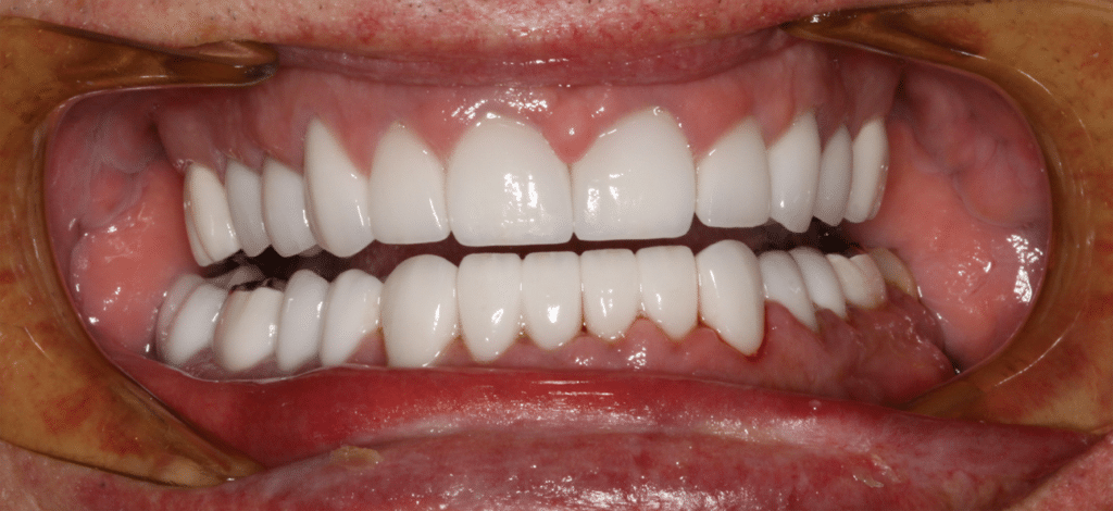 After Image: Full Mouth Reconstruction - front