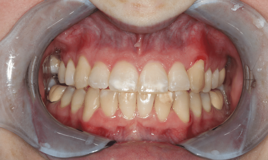 After Image: Clear Aligner Therapy - front