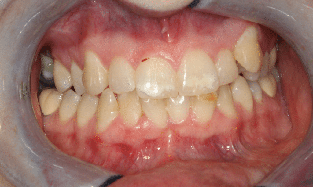 Before Image: Clear Aligner Therapy - front