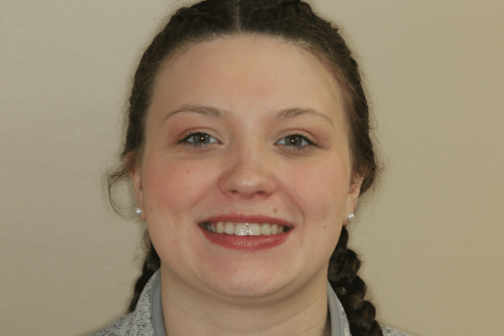 After Image: Clear Aligner Therapy - front