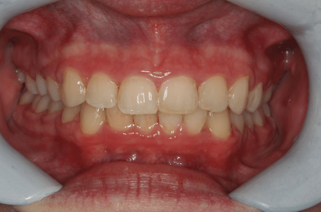 After Image: Clear Aligner Therapy - front