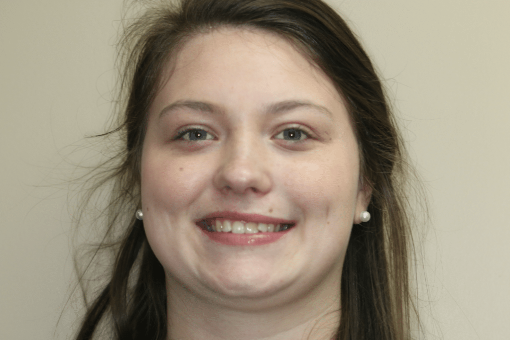 Before Image: Clear Aligner Therapy - front