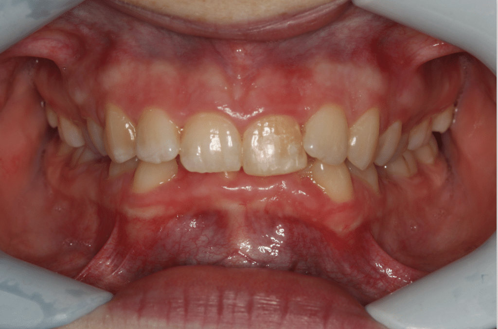 Before Image: Clear Aligner Therapy - front