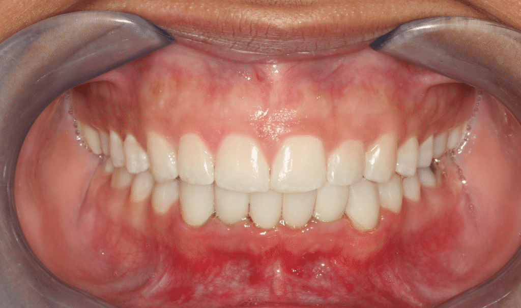 After Image: Two Lower Dental Implants, Clear Aligner Therapy, Lower Veneers - front