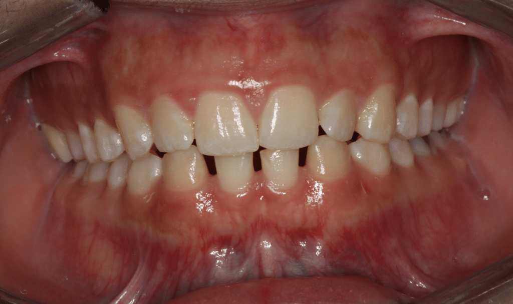 Before Image: Two Lower Dental Implants, Clear Aligner Therapy, Lower Veneers - front