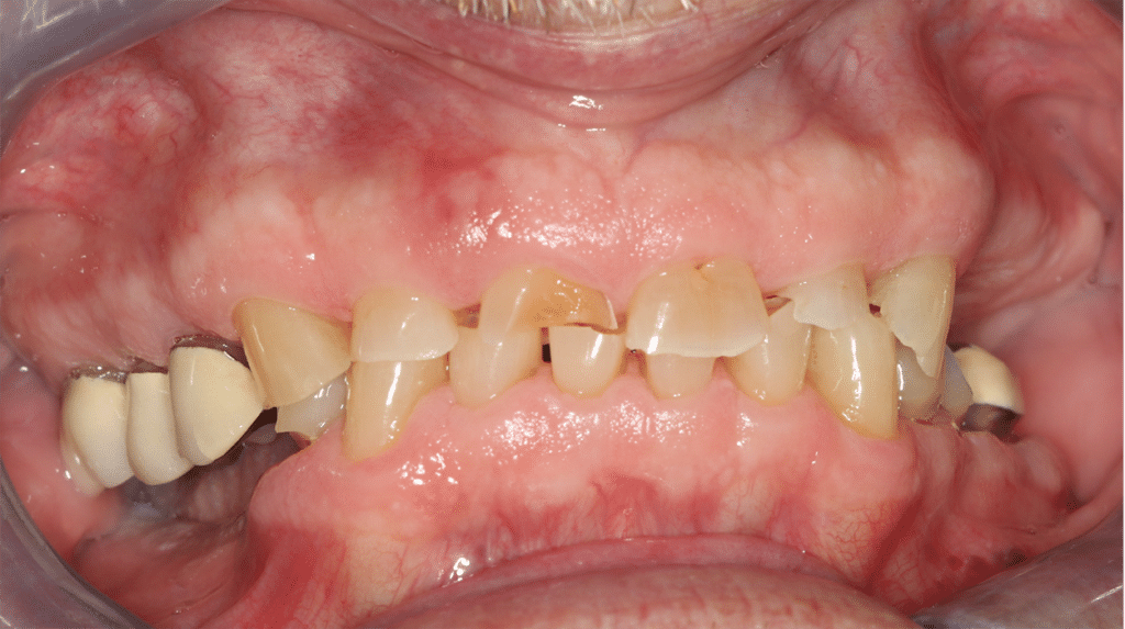 Before Image: Full Mouth Reconstruction - front