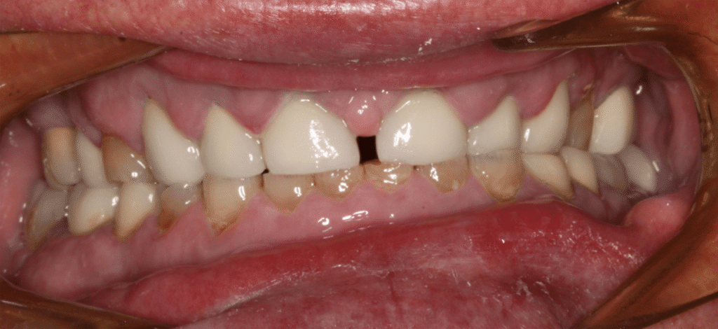 Before Image: Full Mouth Reconstruction - front