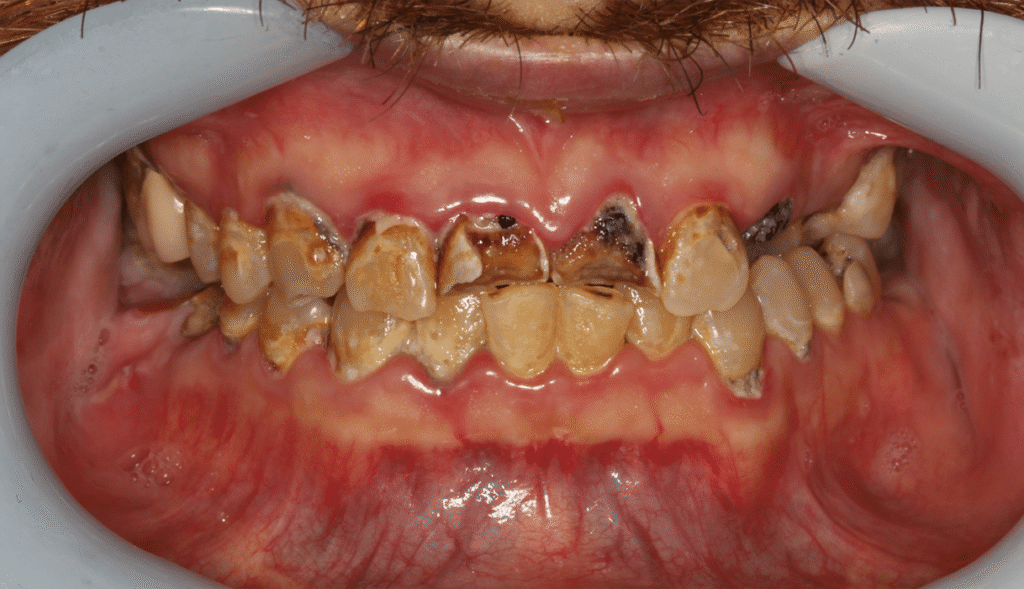 Before Image: All on X Implant Supported Prosthesis - front