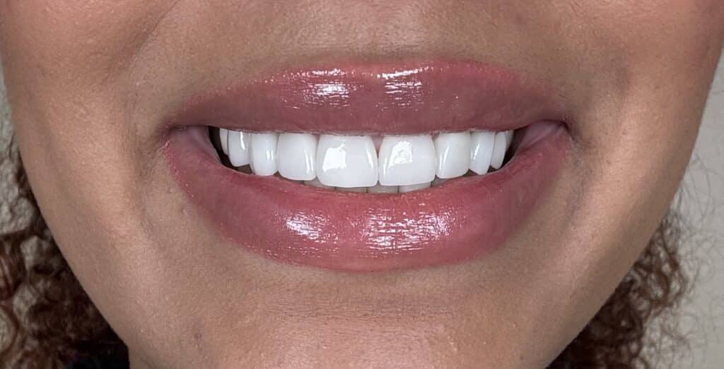 After Image: Veneers - front