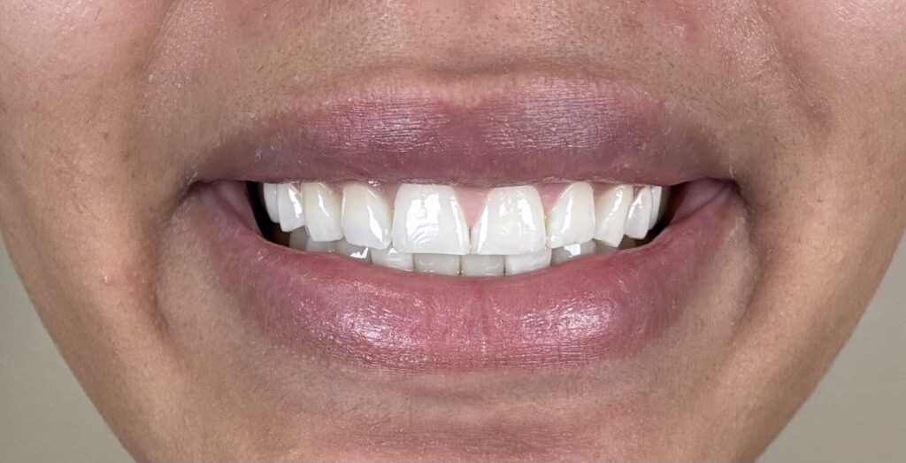 Before Image: Veneers - front